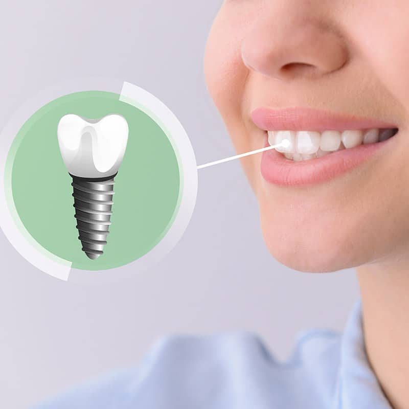 Cinderella-Esthetic-Care-tandheelkunde-in-Turkije-implantaten-iets-voor-u