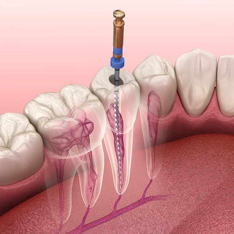 Cinderella-Esthetic-Care-tandheelkunde-in-Turkije-wortelkanaal-behandeling-iets-voor-u